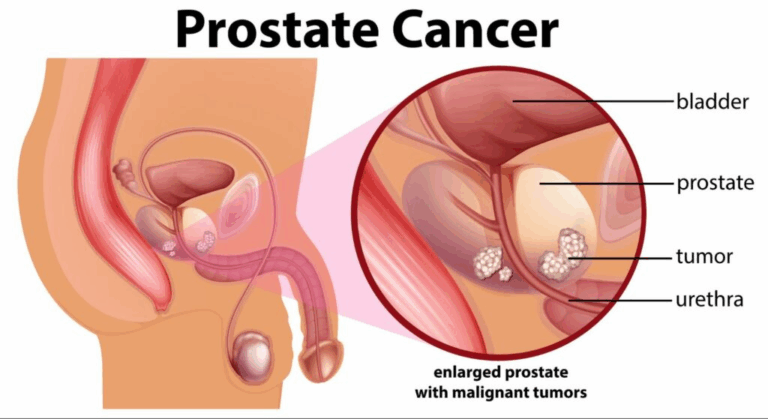 BPH vs Prostate Cancer: PSA Levels Explained