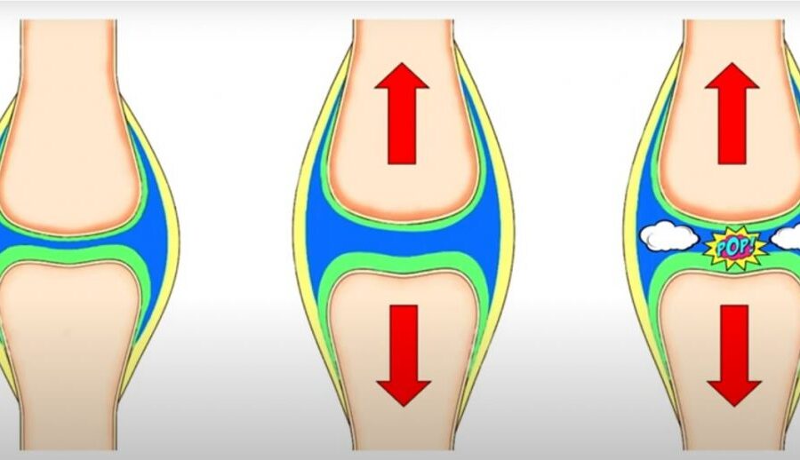 Illustration of knee joint showing gas bubbles and popping sound during movement