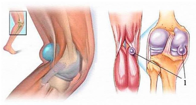 Medical illustration of Baker’s cyst behind the knee joint
