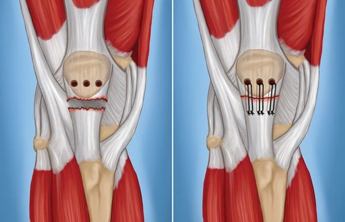 Medical illustration of knee surgery showing ligament and tendon repair