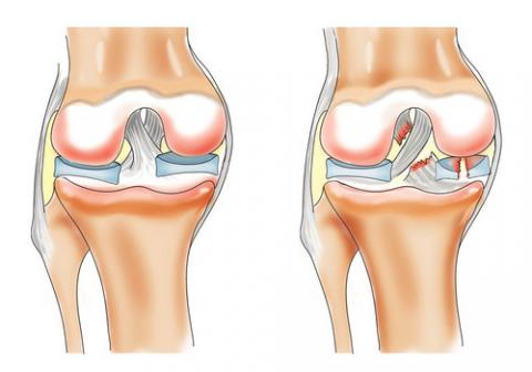 Illustration of meniscus tear inside the knee joint