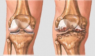 Knee joint illustration showing healthy cartilage versus osteoarthritis damage