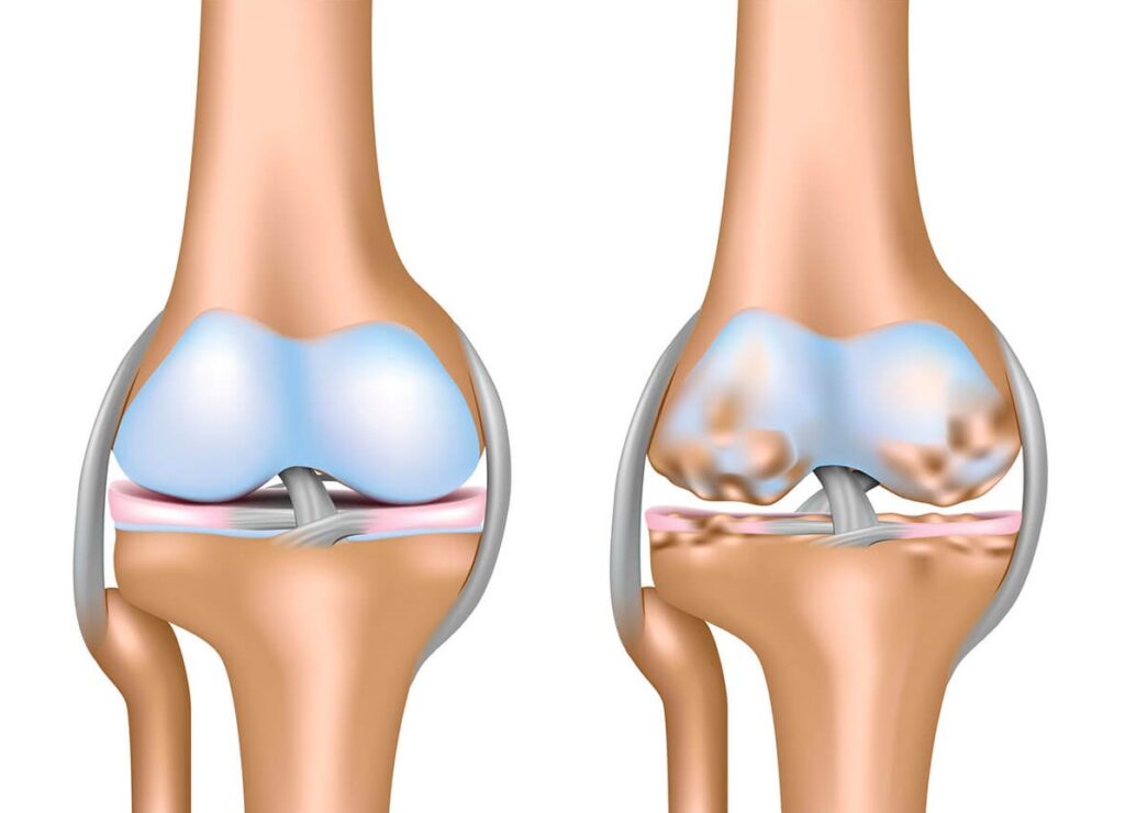 Comparison of healthy knee joint and knee with osteoarthritis damage