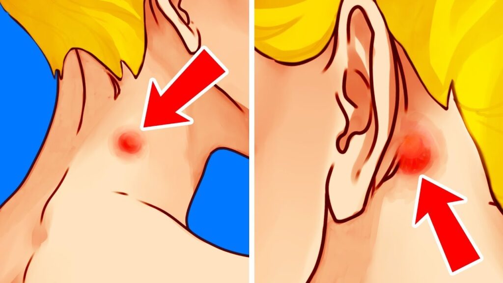 medical illustration showing lump on back of neck highlighted
