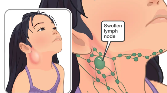 Illustration showing thyroid gland position and thyroid nodules